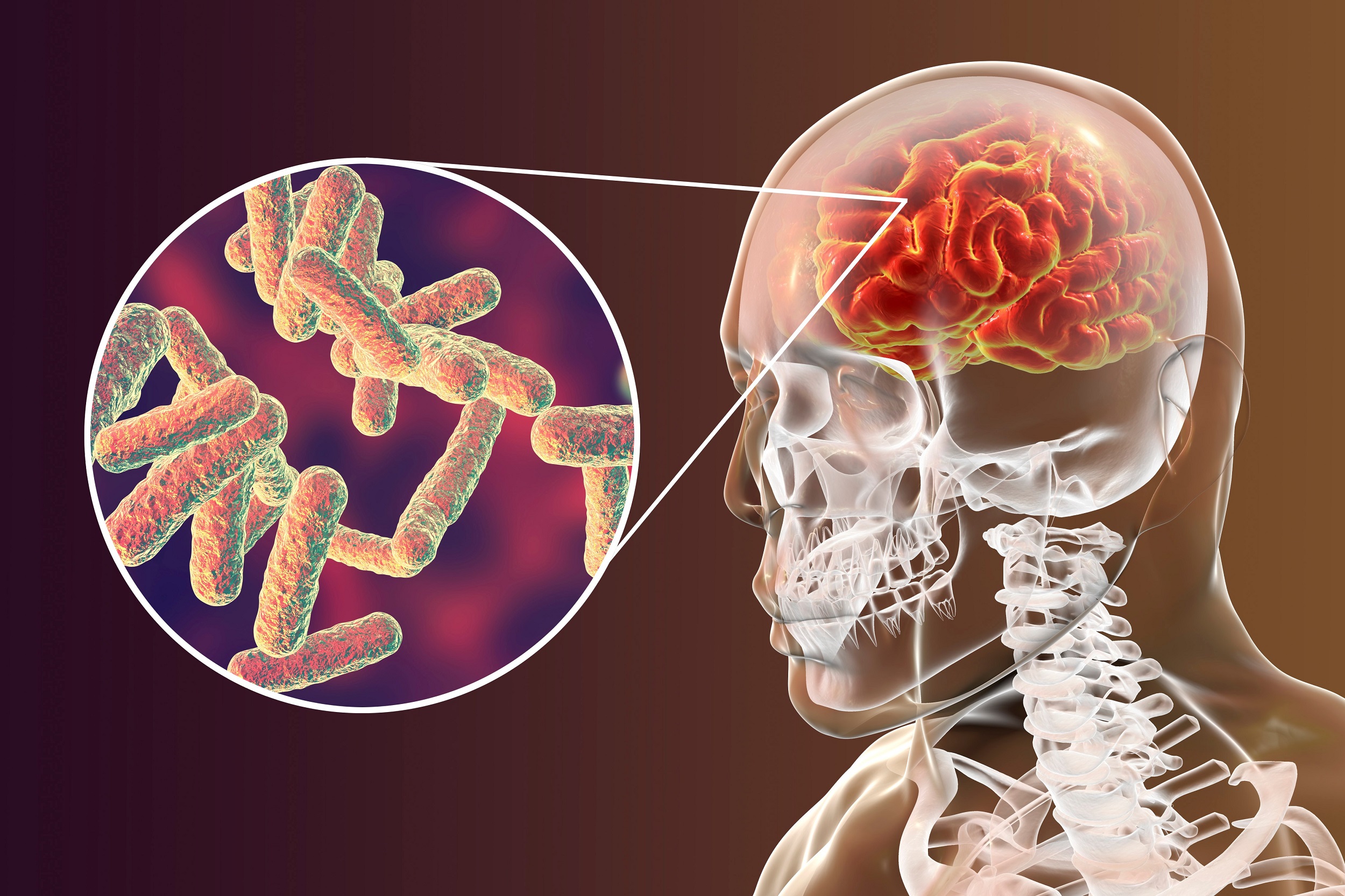 4 Fatos Sobre A Meningite Meningocócica - Vacine Clínica